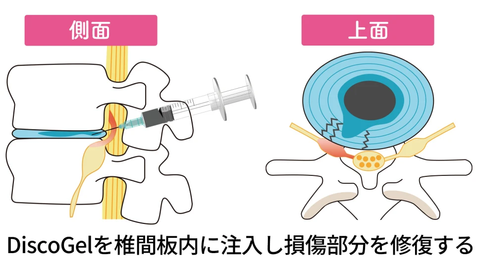 DiscoGelを椎間板内に注入し損傷部分を修復する