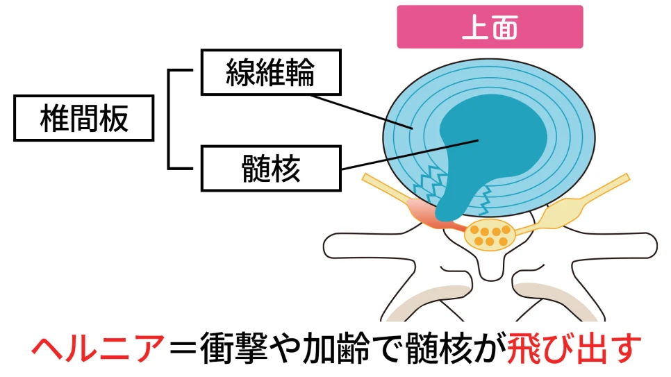 ヘルニア=衝撃や加齢で髄核が飛び出す